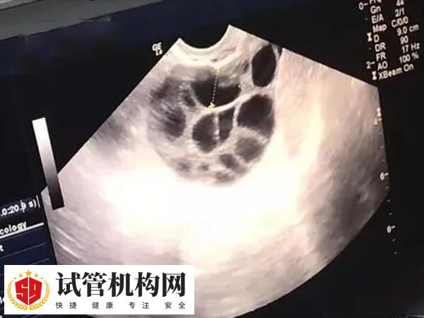 卵泡难以发育成熟会引起闭经