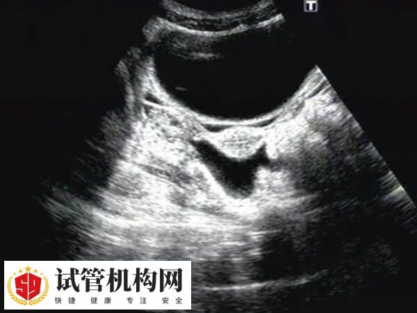 鲜胚移植后宫腔积液多久能吸收
