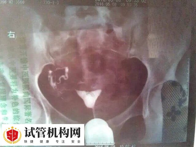 女性结扎了能不能做试管婴儿
