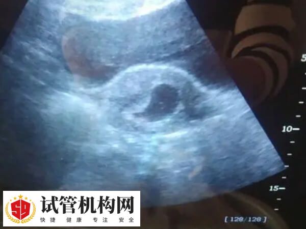 移植19天胚胎发育怎么样